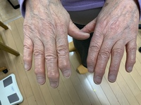 へバーデン結節による指の痛み